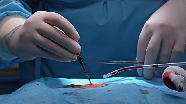 Surgical forceps removed from man's stomach after 18 years