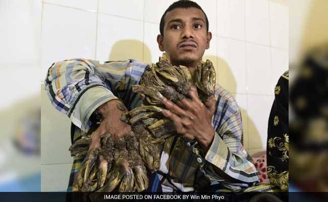 'Tree Man' in Bangladesh Sees Hope After 16 Surgeries
