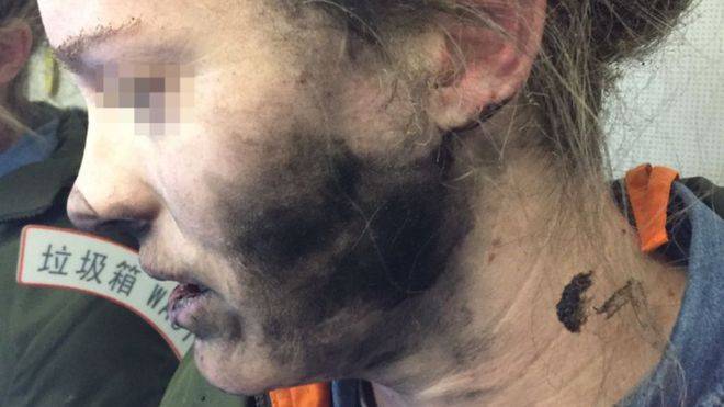 Headphones explosion leaves woman with blisters