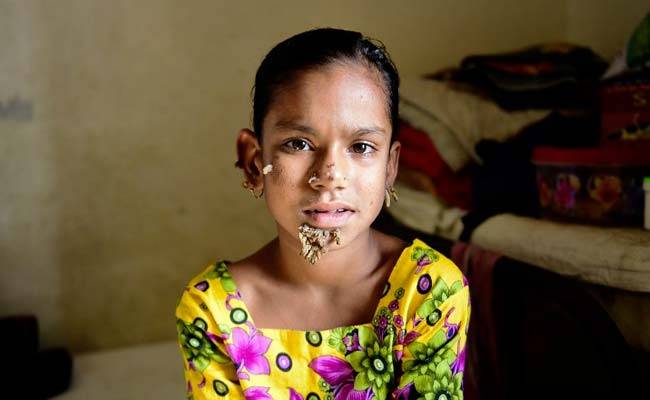 Bangladesh “Tree Girl” ends as scared father stop it