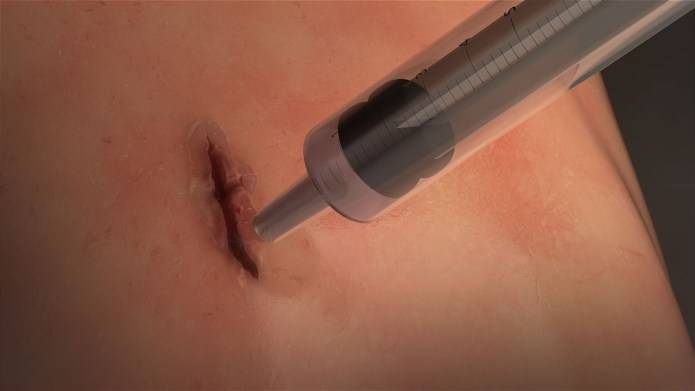 Scientists invents surgical glue able to seal wound in 60 second