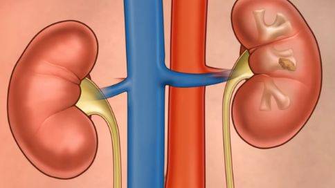 Oral antibiotics increase risk of kidney stones: study