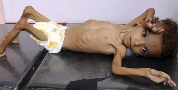 Over seven million children in Yemen face severe food insecurity: UNICEF
