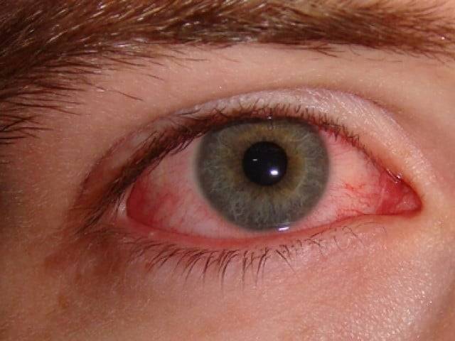 Punjab reports 15,105 new cases of pink eye infection in 24 hours