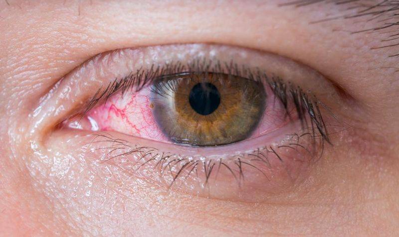 Punjab reports over 10,000 new cases of pink eye infection in 24 hours